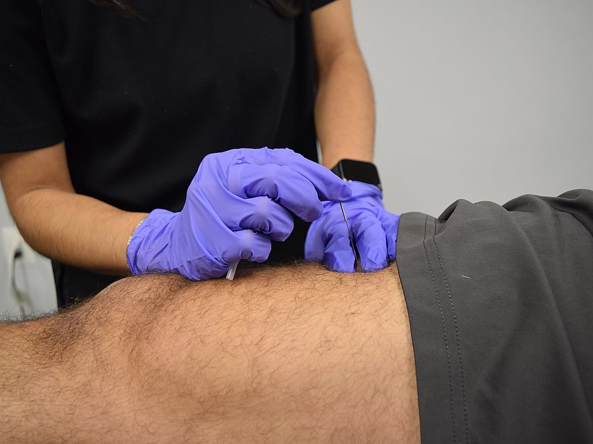 Trigger point dry needling being performed on a patient's leg